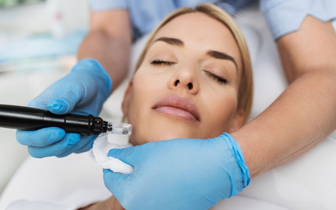 What Is RF Microneedling and Is It Right for You?