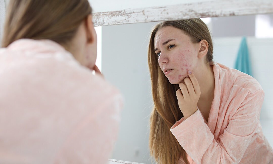 How to Clear Acne: The Best Treatments for Stubborn Breakouts