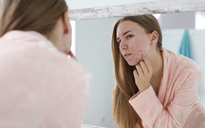 How to Clear Acne: The Best Treatments for Stubborn Breakouts