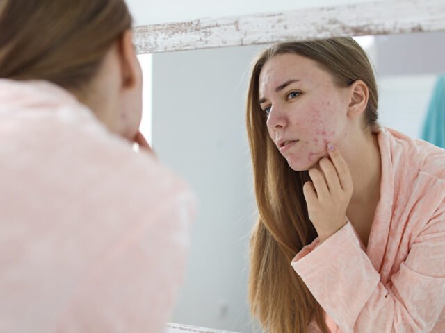 How to Clear Acne: The Best Treatments for Stubborn Breakouts