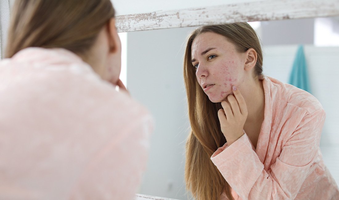 Young woman with acne problem, looking in the mirror discouraged. June is Acne Awareness Month. Schedule a consultation with The Beauty Method today!