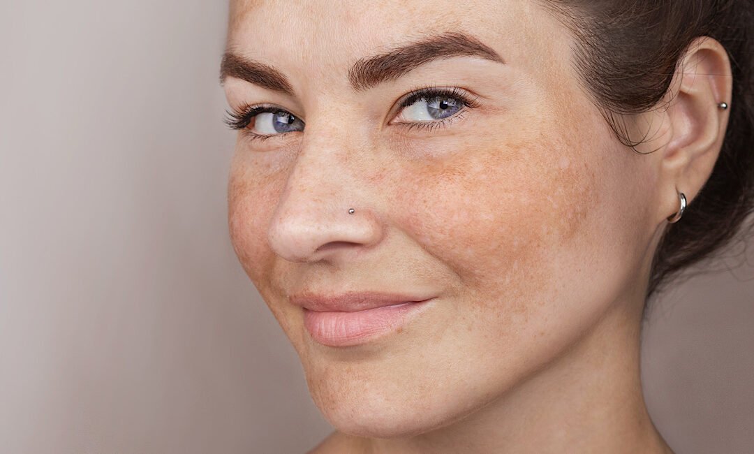 Top Treatments for Melasma During Arizona Summers