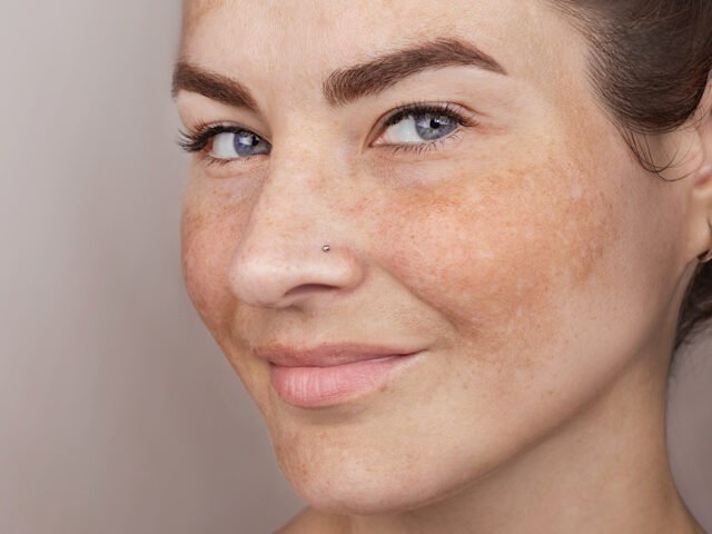 Top Treatments for Melasma During Arizona Summers
