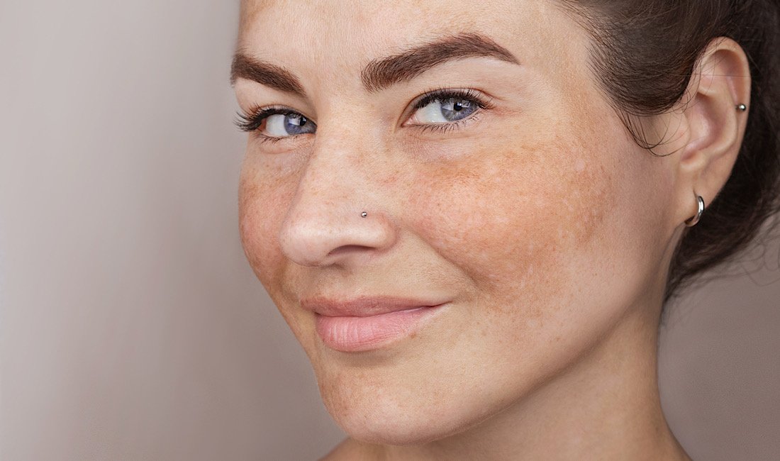 Treat your melasma today at The Beauty Method in Peoria, AZ
